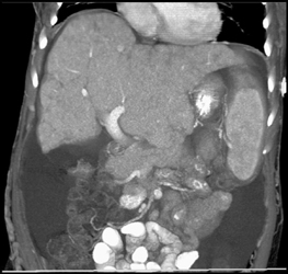 Cirrhosis - CTisus CT Scan