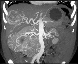 Cirrhosis Plus Renal Cell Carcinoma - CTisus CT Scan