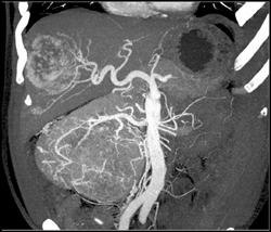 Cirrhosis Plus Vascular Renal Cell Carcinoma (RCC) - CTisus CT Scan