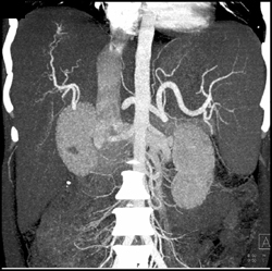 Subtle Hepatocellular Carcinoma (HCC) - CTisus CT Scan