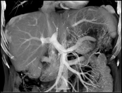 Implants on Liver Surface - CTisus CT Scan