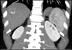 Hemangioma - CTisus CT Scan