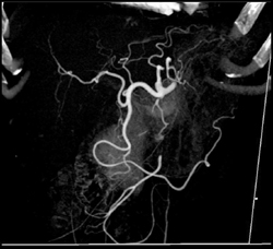 Normal Hepatic Artery - CTisus CT Scan