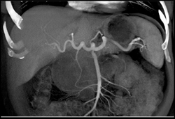 Normal Hepatic Artery - CTisus CT Scan