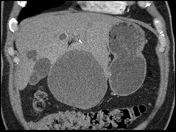 Liver Cysts - CTisus CT Scan