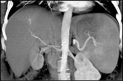 Hepatoma With Subtle Neovascularity - CTisus CT Scan