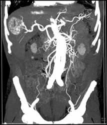 Hemangioma - CTisus CT Scan