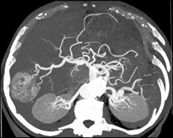 Hemangioma - CTisus CT Scan