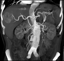 Hemangioma - CTisus CT Scan