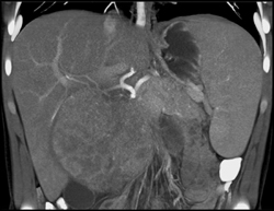 Hepatoma - CTisus CT Scan