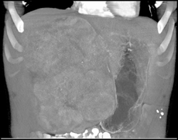 Hepatoma - CTisus CT Scan