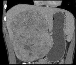 Hepatoma - CTisus CT Scan