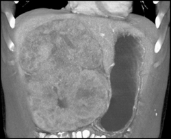 Hepatoma - CTisus CT Scan