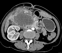 Gallbladder Cancer - CTisus CT Scan