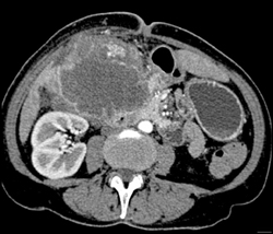 Gallbladder Cancer - CTisus CT Scan