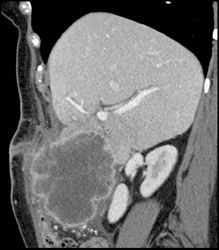 Gallbladder Cancer - CTisus CT Scan