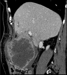 Gallbladder Cancer - CTisus CT Scan