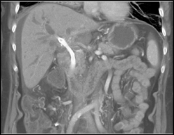 Cholangiocarcinoma - CTisus CT Scan