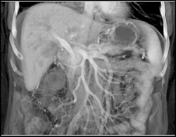 Cholangiocarcinoma - CTisus CT Scan