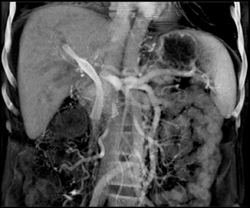 Cholangiocarcinoma - CTisus CT Scan