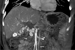 Cavernous Transformation of the Portal Vein - CTisus CT Scan