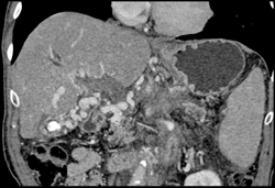 Cavernous Transformation of the Portal Vein - CTisus CT Scan