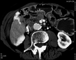 Collaterals Around Liver Border - CTisus CT Scan