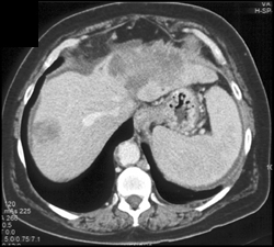 Liver Metastases and Paracardiac Nodes - CTisus CT Scan