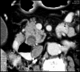 Stone Impacted in Distal Common Bile Duct (CBD) - CTisus CT Scan