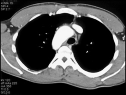 Situs Inversus - CTisus CT Scan