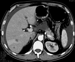 Flow Related Perfusion Changes Due to Liver Metastases - CTisus CT Scan