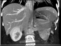 Variant Hepatic Venous Anatomy - CTisus CT Scan