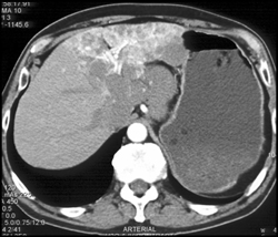 Unusual Hemangioma in Left Lobe of Liver - CTisus CT Scan