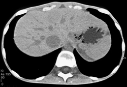 Amazing Case of Hydatid Cyst in 26 Year Old Female - CTisus CT Scan