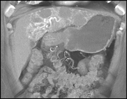 Hemangioma - CTisus CT Scan