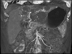 Hemangioma - CTisus CT Scan