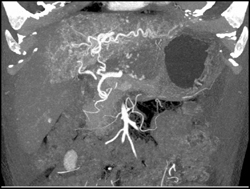 Hemangioma - CTisus CT Scan