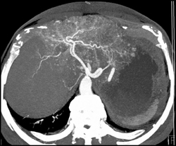 Hemangioma - CTisus CT Scan