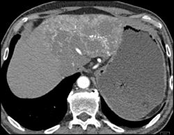 Hemangioma - CTisus CT Scan