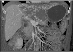 Hemangioma - CTisus CT Scan