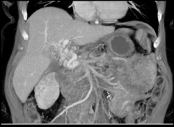 Cavernous Transformation of the Portal Vein - CTisus CT Scan