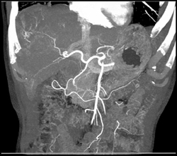 Hepatoma - CTisus CT Scan