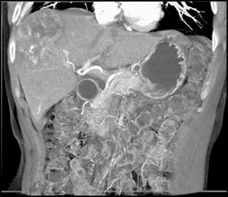 Hepatoma - CTisus CT Scan