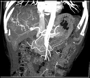 Hepatoma - CTisus CT Scan