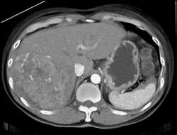 Hepatoma - CTisus CT Scan