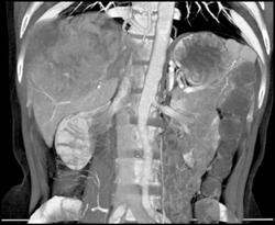 Hepatoma - CTisus CT Scan