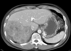 Hepatoma - CTisus CT Scan