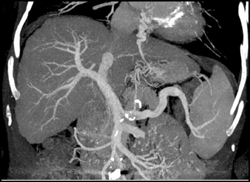 Cirrhosis With Varices - CTisus CT Scan