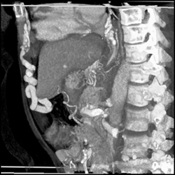 Cirrhosis With Varices - CTisus CT Scan