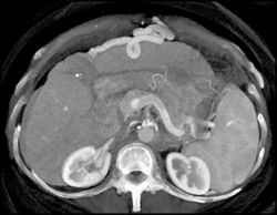 Incredible Umbilical Vein - CTisus CT Scan